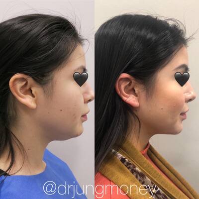 How Much Does Eye Lift Surgery Cost? What to Expect from Tummy 