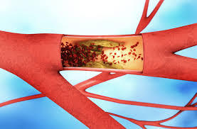 Peripheral Artery Disease Market Size, Growth Analysis 2028